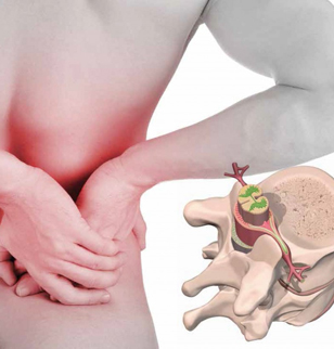 Грыжа диска (позвоночная грыжа)